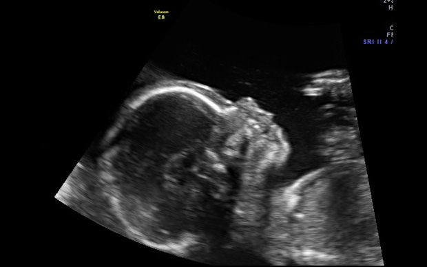 Trimester ultrasound second Second trimester